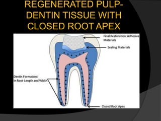 REGENERATED PULP-
DENTIN TISSUE WITH
CLOSED ROOT APEX
 