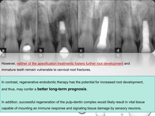However, neither of the apexification treatments fosters further root development and
immature teeth remain vulnerable to cervical root fractures.
In contrast, regenerative endodontic therapy has the potential for increased root development,
and thus, may confer a better long-term prognosis.
In addition, successful regeneration of the pulp-dentin complex would likely result in vital tissue
capable of mounting an immune response and signaling tissue damage by sensory neurons.
 