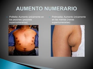  Politelia: Aumento únicamente en
los pezones (pezones
supernumerarios)
 Polimastia: Aumento únicamente
en las mamas (nanas
supernumerarias)
 