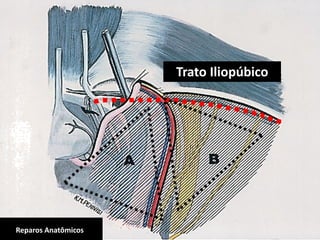 ANATOMIA CIRÚRGICA DA REGIÃO INGUINALReparos Anatômicos
Trato Iliopúbico
 