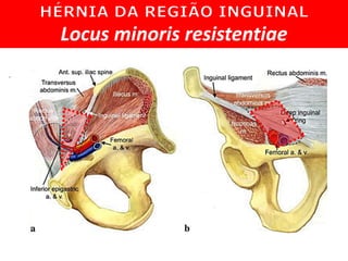 Locus minoris resistentiae
 