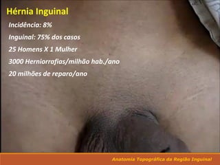 Hérnia Inguinal
Incidência: 8%
Inguinal: 75% dos casos
25 Homens X 1 Mulher
3000 Herniorrafias/milhão hab./ano
20 milhões de reparo/ano
Anatomia Topográfica da Região Inguinal
 