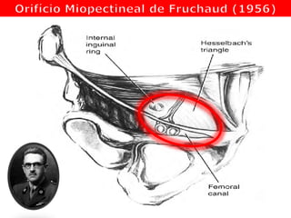 Limites Anatômicos
S: Tendão Conjunto
I: Ligamento de Cooper
M: Bainha do mm. Reto
L: mm. Iliopsoas
P: Fascia Transversalis
 