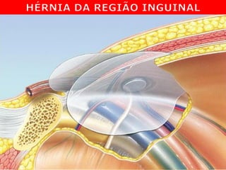 Anatomia Topográfica da Região Inguinal