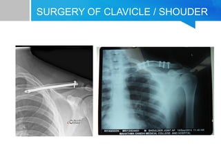 SURGERY OF CLAVICLE / SHOUDER 
 