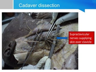 Cadaver dissection 
Supraclavicular 
nerves supplying 
skin over clavicle 
 