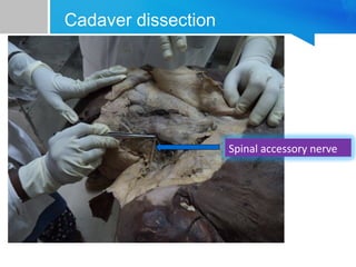 Cadaver dissection 
Spinal accessory nerve 
 