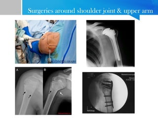 Surgeries around shoulder joint & upper arm 
 
