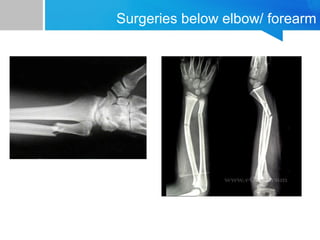 Surgeries below elbow/ forearm 
 
