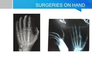 SURGERIES ON HAND 
 