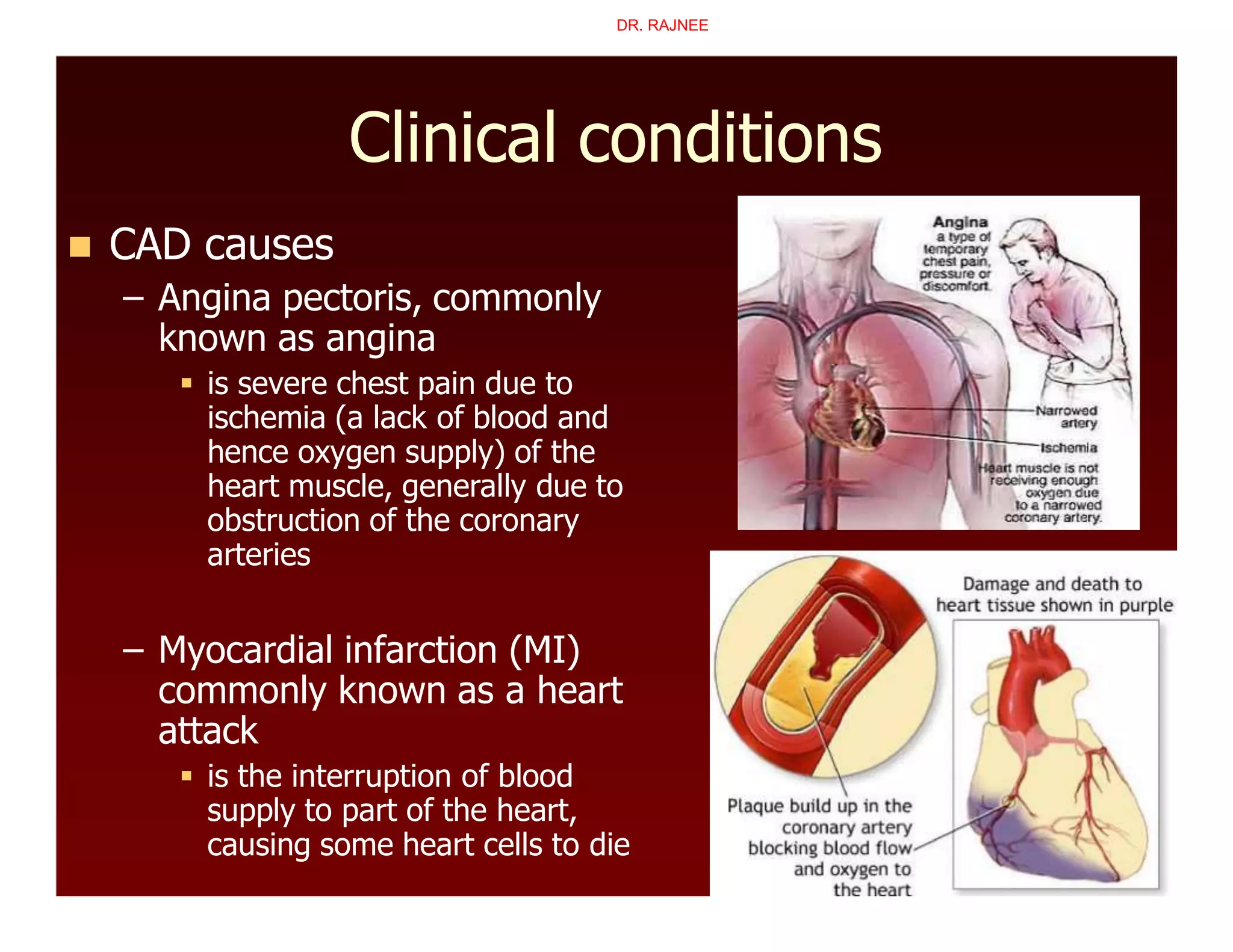 Clinical conditions
 CAD causes
– Angina pectoris, commonly
known as angina
 is severe chest pain due to
ischemia (a lack of blood and
hence oxygen supply) of the
heart muscle, generally due to
obstruction of the coronary
arteries
– Myocardial infarction (MI)
commonly known as a heart
attack
 is the interruption of blood
supply to part of the heart,
causing some heart cells to die
DR. RAJNEE
 