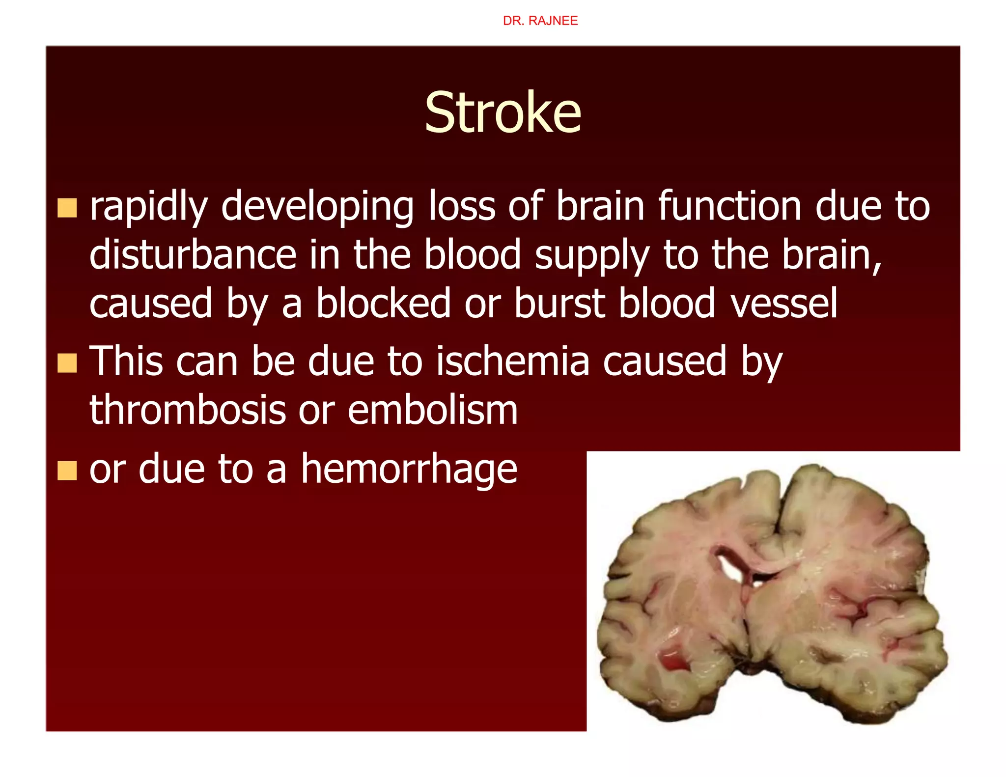 Stroke
 rapidly developing loss of brain function due to
disturbance in the blood supply to the brain,
caused by a blocked or burst blood vessel
 This can be due to ischemia caused by
thrombosis or embolism
 or due to a hemorrhage
DR. RAJNEE
 