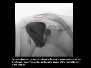 Labeled Sholder Anthrogram Regional conditions of upper limb | PPTX