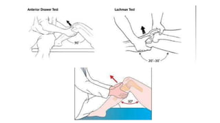 Ligamentous Injuries Around Knee by Dr Arun C Raj, Ortho Resident, KIMS Hubli