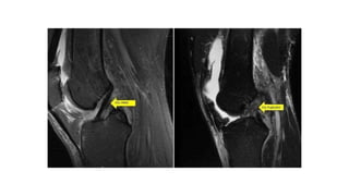 Ligamentous Injuries Around Knee by Dr Arun C Raj, Ortho Resident, KIMS Hubli