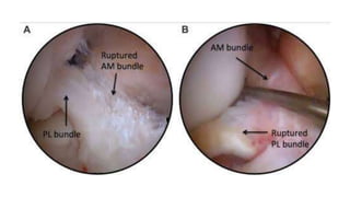 Ligamentous Injuries Around Knee by Dr Arun C Raj, Ortho Resident, KIMS Hubli