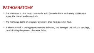 PATHOANATOMY
• The meniscus is torn most commonly at its posterior horn. With every subsequent
injury, the tear extends anteriorly.
• The meniscus, being an avascular structure, once torn does not heal.
• If left untreated, it undergoes many more subtears, and damages the articular cartilage,
thus initiating the process of osteoarthritis.
 