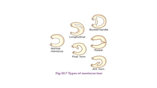Ligamentous Injuries Around Knee by Dr Arun C Raj, Ortho Resident, KIMS Hubli