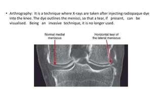 • Arthrography: It is a technique where X-rays are taken after injecting radiopaque dye
into the knee. The dye outlines the menisci, so that a tear, if present, can be
visualised. Being an invasive technique, it is no longer used.
 