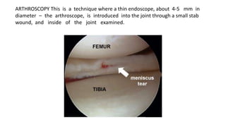 ARTHROSCOPY This is a technique where a thin endoscope, about 4-5 mm in
diameter – the arthroscope, is introduced into the joint through a small stab
wound, and inside of the joint examined.
 