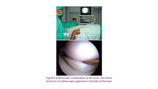 Ligamentous Injuries Around Knee by Dr Arun C Raj, Ortho Resident, KIMS Hubli