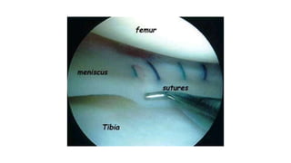 Ligamentous Injuries Around Knee by Dr Arun C Raj, Ortho Resident, KIMS Hubli