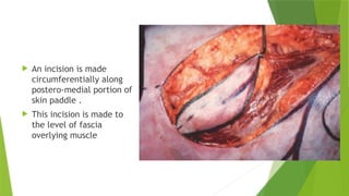Skin Paddle Incision Regional flap Reconstruction in Head & Neck Surgeries | PPTX