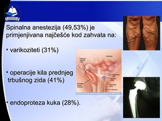 Spinalna anestezija (49,53%) je primjenjivana naj?e??e kod zahvata na: varikoziteti (31%) operacije kila prednjeg trbu?nog zida (41%) endoproteza kuka (28%). 