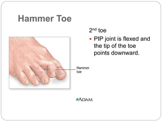 Toe Pip Regional Rheumatic Pain Syndromes | PPTX