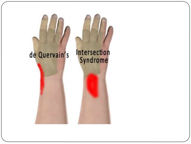 Regional Rheumatic Pain Syndromes