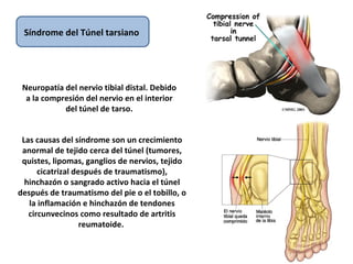 Síndrome del  Túnel tarsiano  Neuropatía del nervio tibial distal. Debido a la compresión del nervio en el interior del túnel de tarso. Las causas del síndrome son un crecimiento anormal de tejido cerca del túnel (tumores, quistes, lipomas, ganglios de nervios, tejido cicatrizal después de traumatismo), hinchazón o sangrado activo hacia el túnel después de traumatismo del pie o el tobillo, o la inflamación e hinchazón de tendones circunvecinos como resultado de artritis reumatoide.  