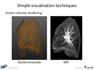 Simple visualization techniques 
Direct volume rendering: 
Double thresholds MIP 
RegistrationShop Noeska Smit 
 