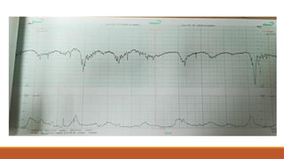 Cardiotocogramme Comprehensive Guide to Fetal Monitoring Using Cardiotocography | PPTX