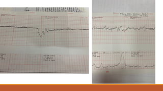 Cardiotocogramme Comprehensive Guide to Fetal Monitoring Using Cardiotocography | PPTX