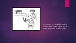 Se aumenta la inclinación condilar
hasta que el cóndilo contacte con la
pared superior de la guía condilar.
 