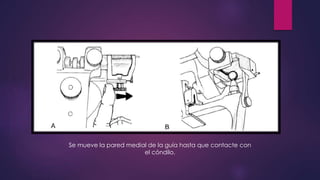 Se mueve la pared medial de la guía hasta que contacte con
el cóndilo.
 