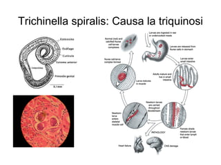 Trichinella spiralis: Causa la triquinosi
 