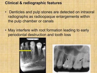 Pulpstone Radiograph Regressive-alterations-(Part-2)-20208191435240.ppt