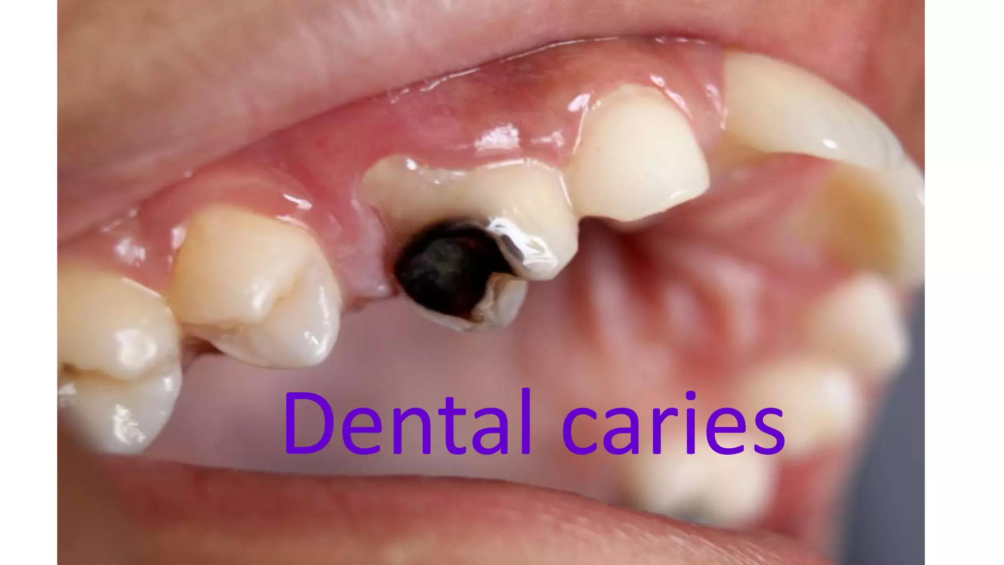 ATTRITION OF TEETH (Regressive Alterations of Teeth) | PPTX