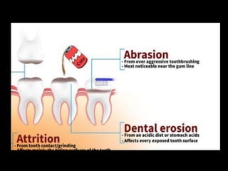 Regressive alterations of teeth | PPTX