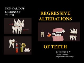 REGRESSIVE
ALTERATIONS
OF TEETH
NON-CARIOUS
LESIONS OF
TEETH
Dr VASANTHI V
Senior Lecturer,
Dept of Oral Pathology
 