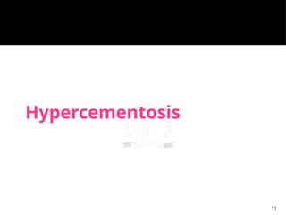 11
Hypercementosis
 