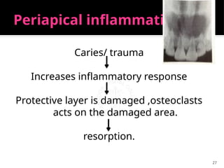 27
Periapical inflammation
Caries/ trauma
Increases inflammatory response
Protective layer is damaged ,osteoclasts
acts on the damaged area.
resorption.
 