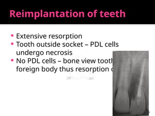 28
Reimplantation of teeth
 Extensive resorption
 Tooth outside socket – PDL cells
undergo necrosis
 No PDL cells – bone view tooth as
foreign body thus resorption occurs
 