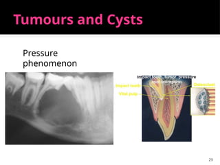 29
Tumours and Cysts
Pressure
phenomenon
 
