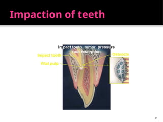 31
Impaction of teeth
 