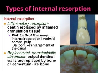 37
Types of internal resorption
 