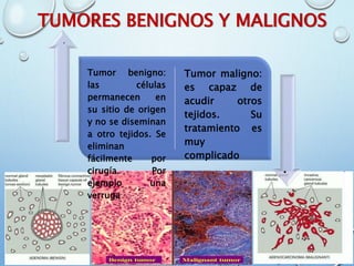 TUMORES BENIGNOS Y MALIGNOS
Tumor benigno:
las células
permanecen en
su sitio de origen
y no se diseminan
a otro tejidos. Se
eliminan
fácilmente por
cirugía. Por
ejemplo una
verruga
Tumor maligno:
es capaz de
acudir otros
tejidos. Su
tratamiento es
muy
complicado
.
.
 