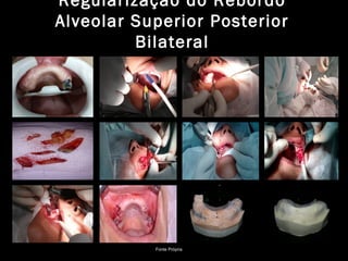 Regularização do Rebordo
Alveolar Superior Posterior
Bilateral
Fonte Própria
 