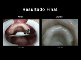 Resultado Final
Fonte Própria Fonte Própria
Antes Depois
 